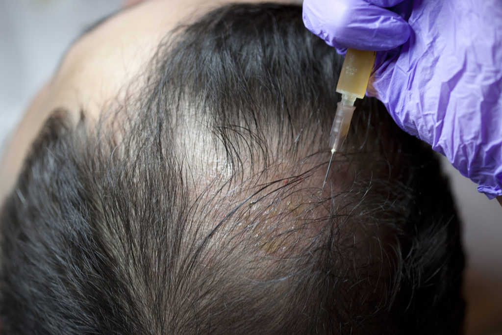 PRP Hair Restoration – What is it and is it Effective? 