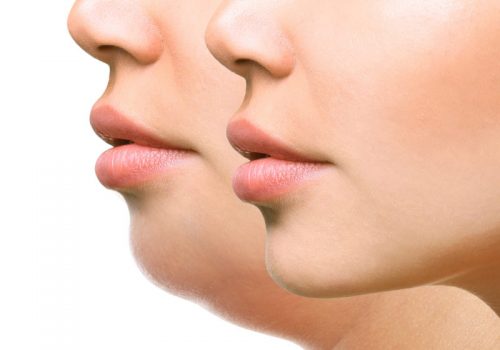 Double Chin Reduction: Is it Even Possible?