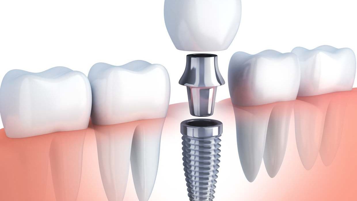 When Should You Consider Getting Dental Implants in Ontario?
