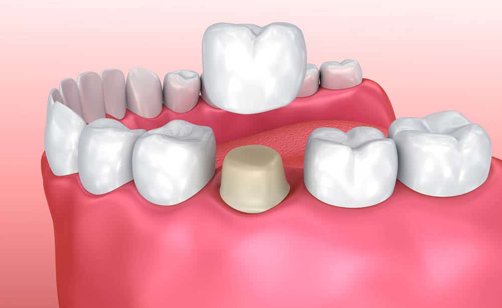 Why Getting Dental Crowns is More Beneficial? – Some Key Facts Revealed