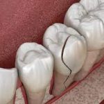 How to Handle a Cracked Tooth Quickly