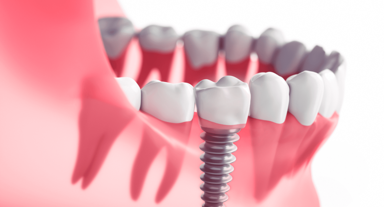 A Complete Guide to Same Day Dental Implants: Benefits, Procedure