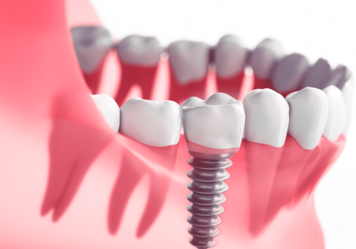 A Complete Guide to Same Day Dental Implants: Benefits, Procedure